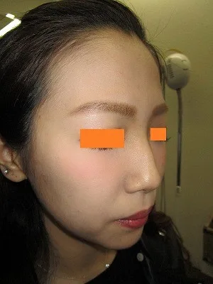 隆鼻術（ヒアルロン酸）の施注前