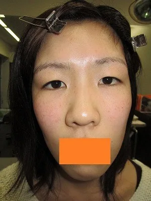 二重瞼（切開法）の術前