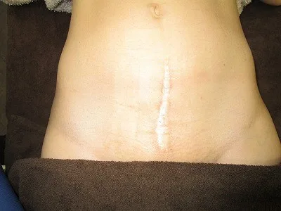 帝王切開後の傷跡修正の術前