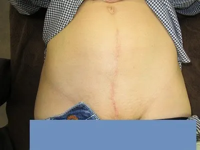 帝王切開後の傷跡修正の術後