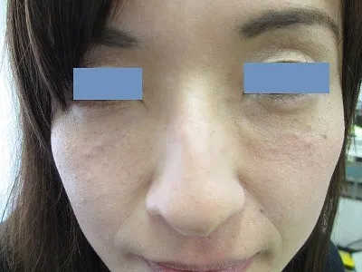 目の下　ヒアルロン酸の施注後