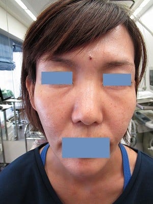 頬、こめかみへのヒアルロン酸の施注後