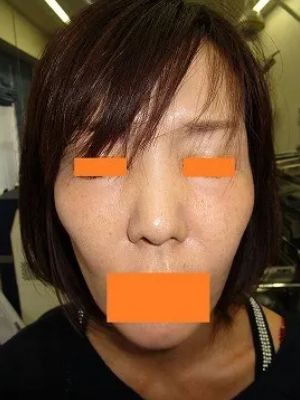 頬、こめかみへのヒアルロン酸の施注前