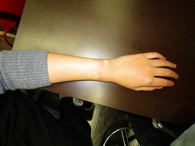 タトゥー（刺青）除去の術後