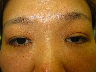 眼瞼下垂の術前