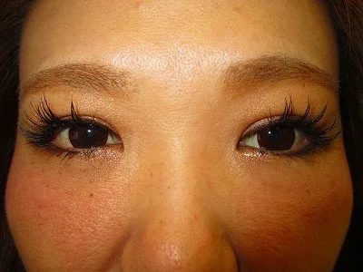 眼瞼下垂の術後