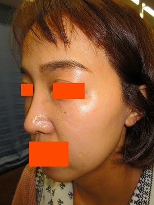 隆鼻術（ヒアルロン酸）の施注後