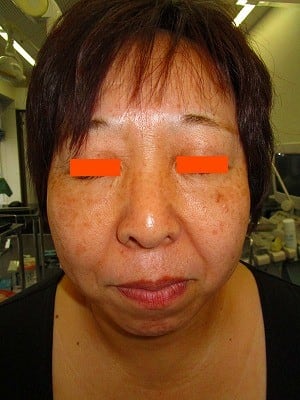 二重あごの治療（顎下の脂肪摘出術）の術前