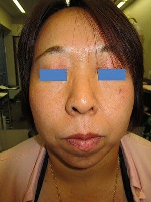 二重あごの治療（顎下の脂肪摘出術）の術後