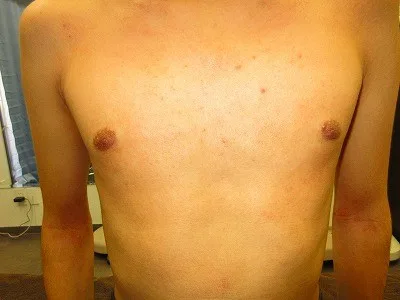 乳頭縮小（男性）の術後