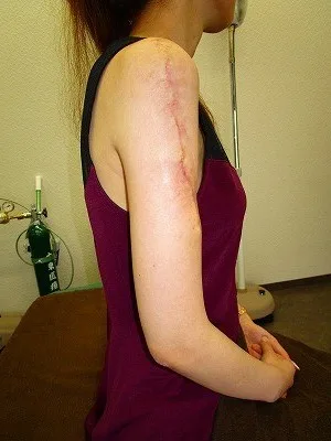 タトゥー（刺青）除去の術後