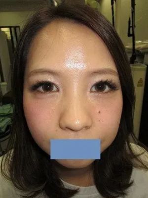 二重瞼（切開法）、目頭切開の術後