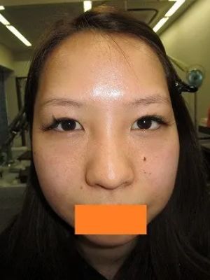 二重瞼（切開法）、目頭切開の術前