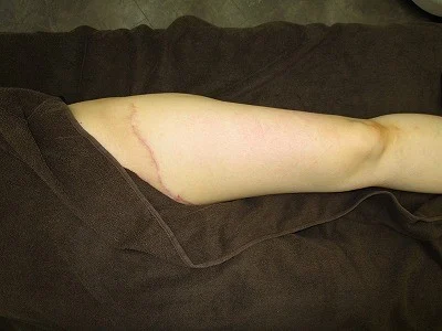 タトゥー（刺青）除去の術後