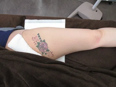 タトゥー（刺青）除去の術前