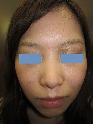 鼻翼縮小の術後