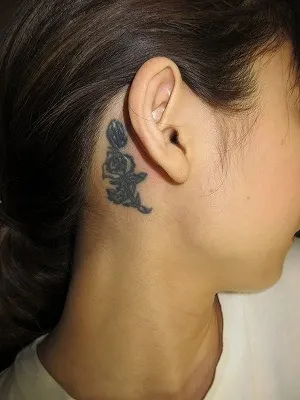 タトゥー（刺青）除去の術前