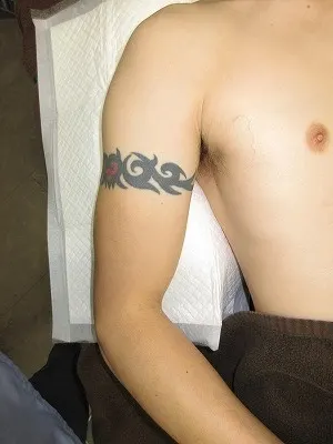 タトゥー（刺青）除去の術前