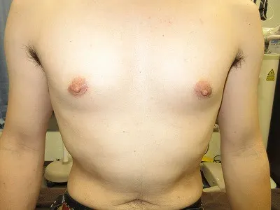 乳頭縮小（男性）の術前