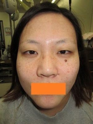 眼瞼下垂の術前