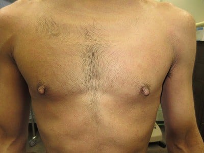 乳頭縮小（男性）の術前