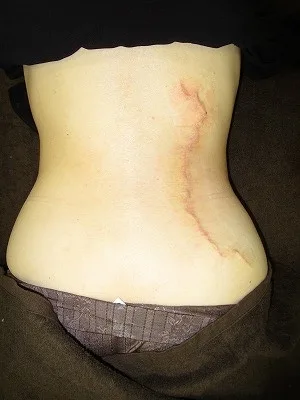 タトゥー（刺青）除去の術後