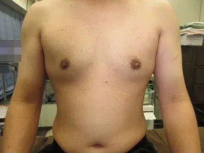 乳頭縮小（男性）（FtM）の術後