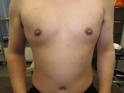 乳頭縮小（男性）（FtM）の術前