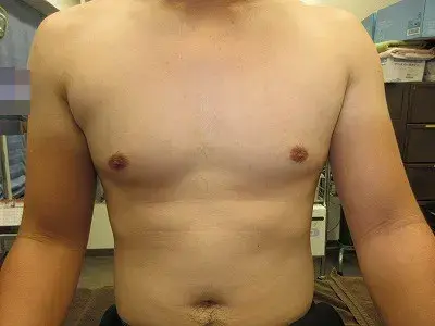 乳頭縮小（男性）の術後