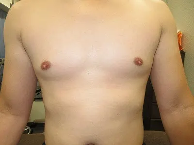 乳頭縮小（男性）の術前