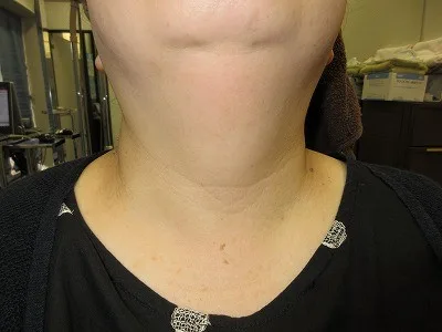 首のイボの術前