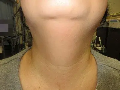 首のイボの術後