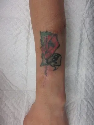 タトゥー（刺青）除去の1回目術後