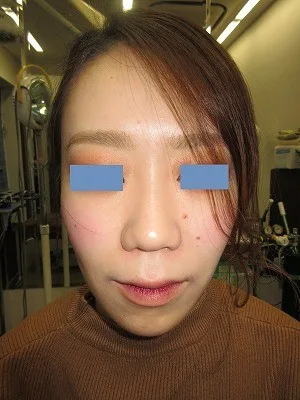 鼻翼縮小の術後