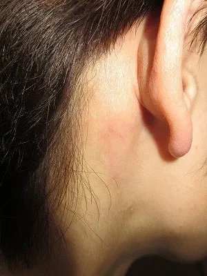 タトゥー（刺青）除去の術後