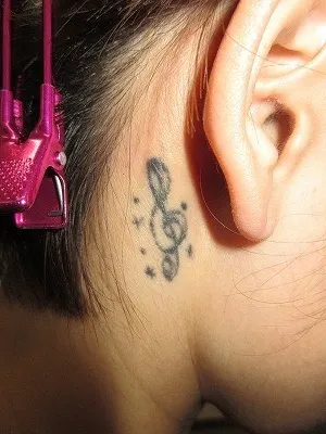 タトゥー（刺青）除去の術前