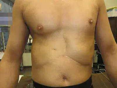 乳頭縮小（男性）の術前