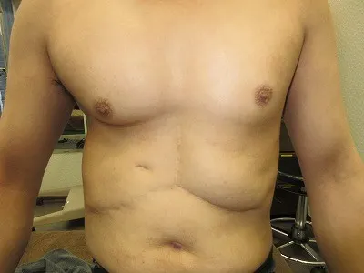 乳頭縮小（男性）の術後