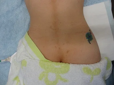 タトゥー（刺青）除去の術前