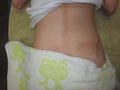 タトゥー（刺青）除去の術後