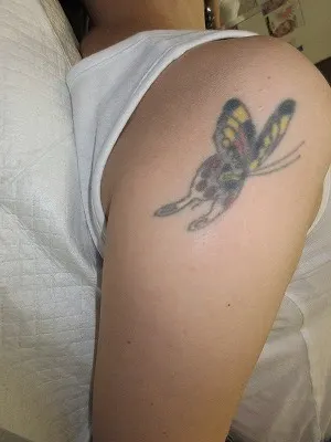 タトゥー（刺青）除去の術前