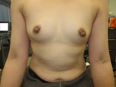 乳頭縮小（女性）の術前