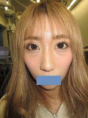 二重瞼（埋没法）の術後