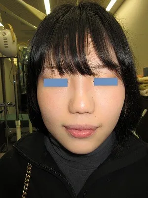 鼻翼縮小の術後