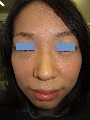 経結膜脱脂法（目の下のふくらみ取り）の術後