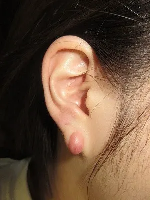 ピアスケロイドの術前