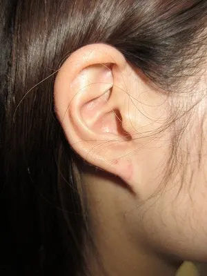 ピアスケロイドの術後