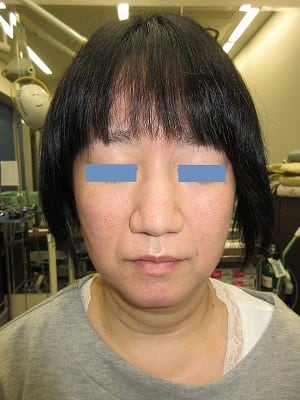 鼻尖形成術の術後