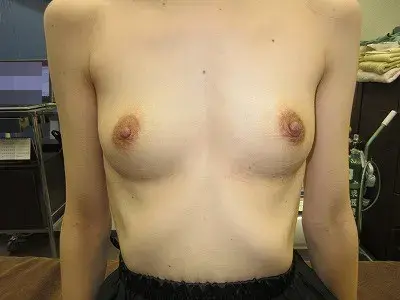 乳頭縮小（女性）の術後