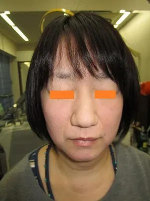 鼻尖形成術の術前